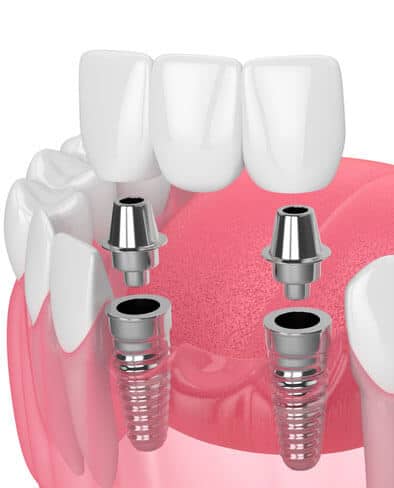 cavities or missing teeth