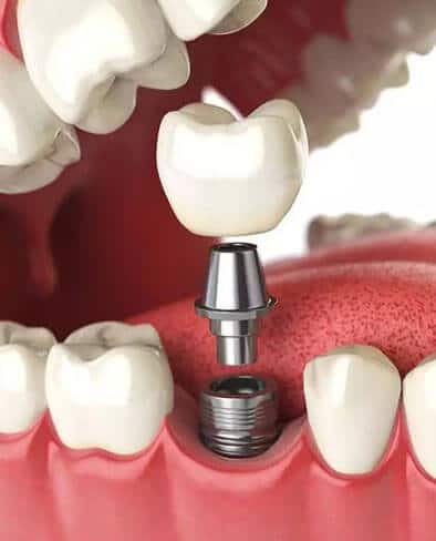 Dental implant Treatment