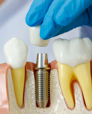 Dental Implants Chandler