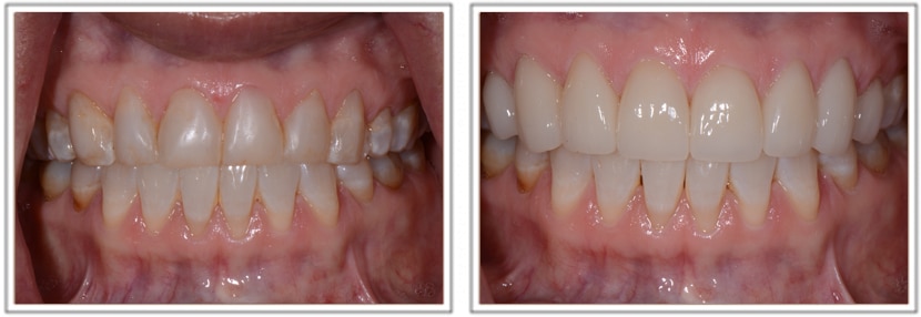 Veener Treatment Before After