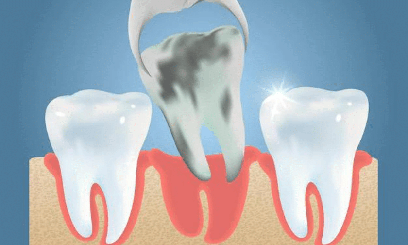 What Are The Benefits Of Wisdom Teeth Removal