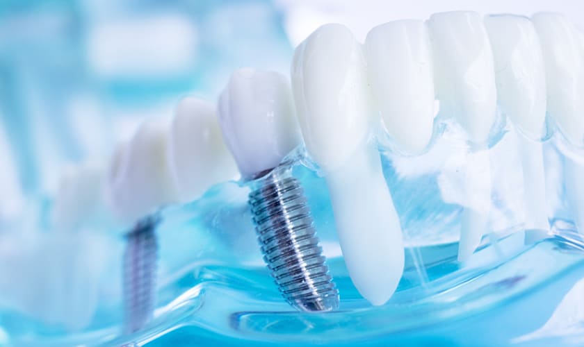 Why Replace Missing Teeth With Dental Implant?