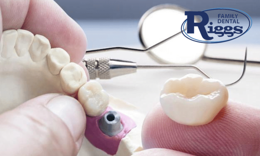 Facts To Know About Same-Day Dental Crowns