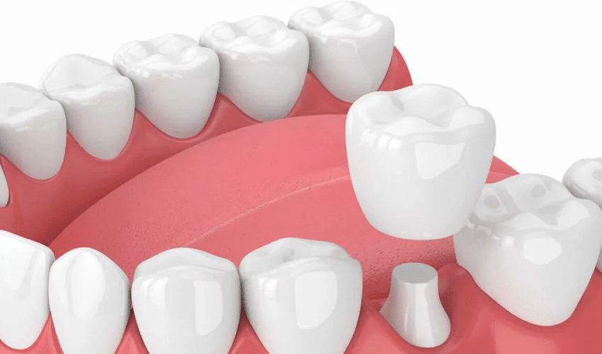 Benefits of Same-Day Crowns