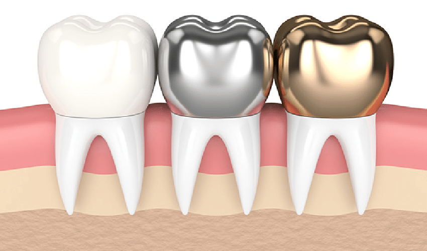 3 Ways to Protect Your Dental Crown