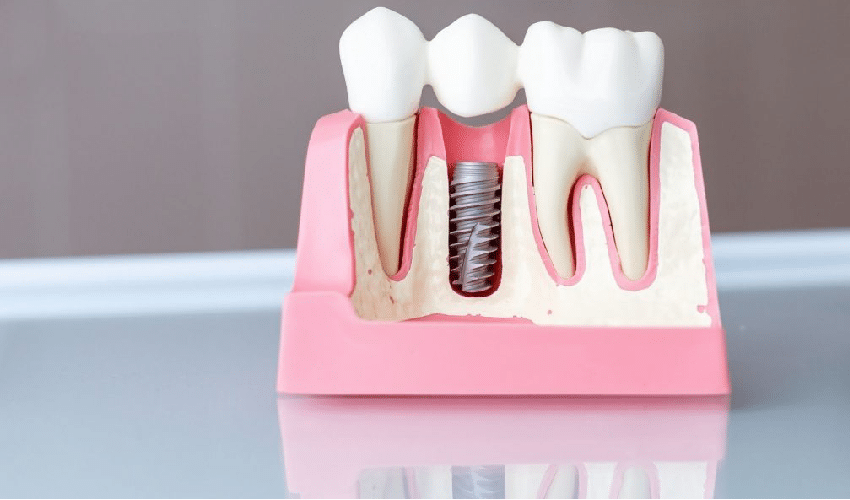 How To Prevent Infection After Dental Implants?