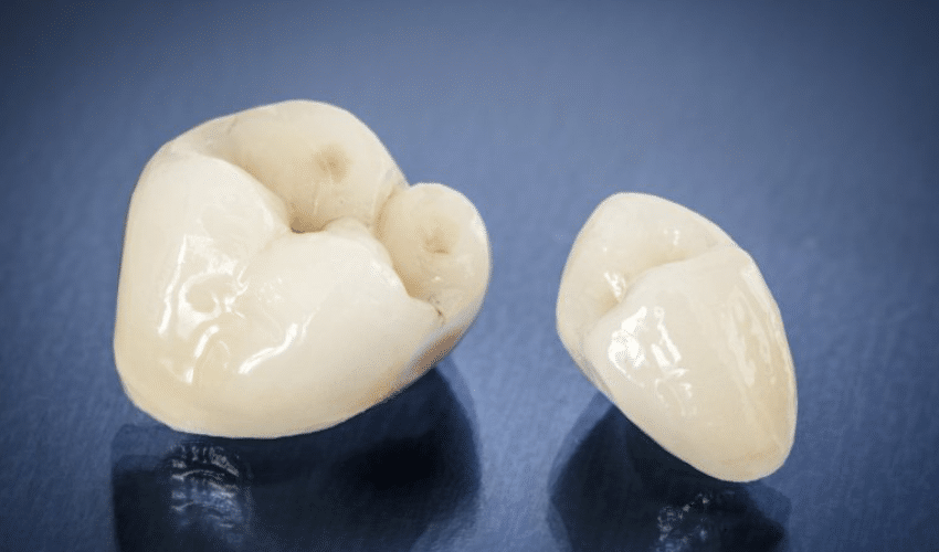 Things To Know About A Broken Dental Crown
