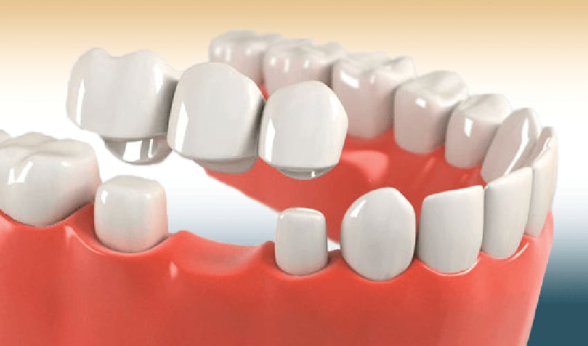How to Fix the Most Frequent Challenges of Dental Crowns