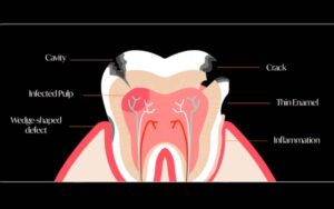 Dental Cavities Dentist in Chandler AZ at Riggs Family Dental