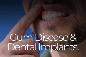 Dental Implants with Gum Disease at Riggs Family Dental Chandler AZ
