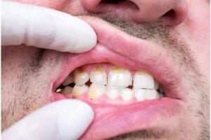 Crack Tooth Treatment - Dental Emergencies Tips at Riggs Family Dental Chandler AZ