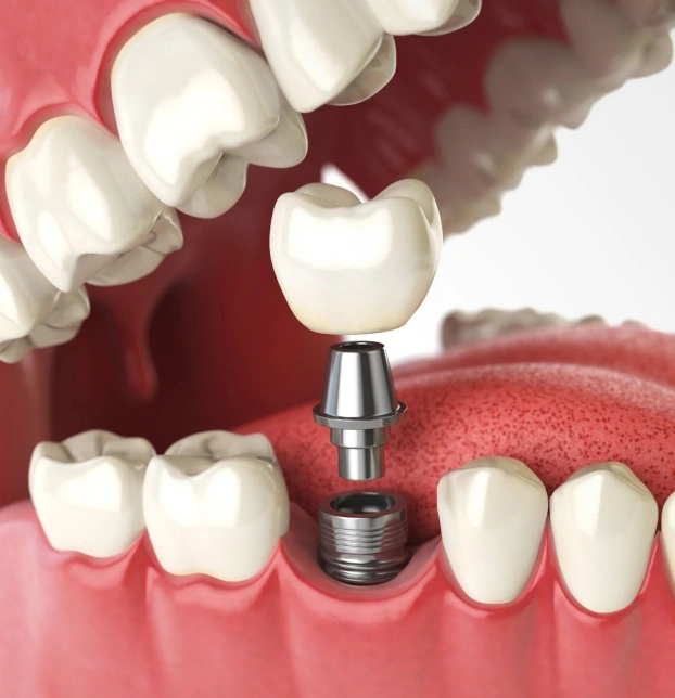 Keep Your Smile Long Lasting with the Dental Implants in Chandler AZ