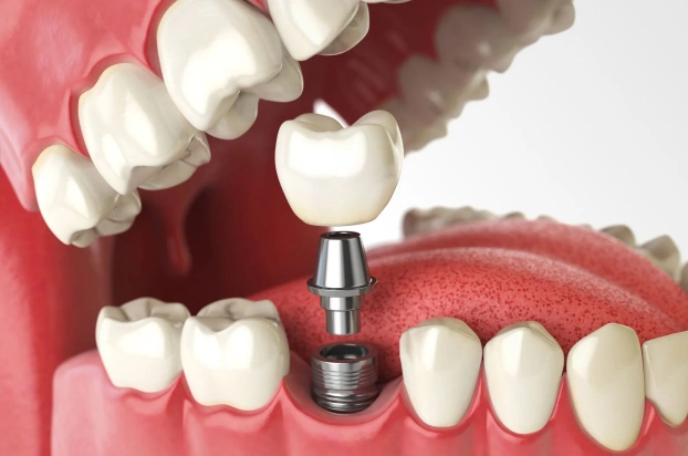 Dental implant model showing tooth crown attachment to implant post in jawbone replica.