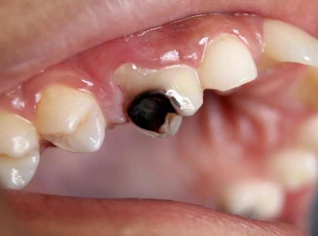 Close-up view of dental implant in lower jaw showing dark implant post between natural teeth