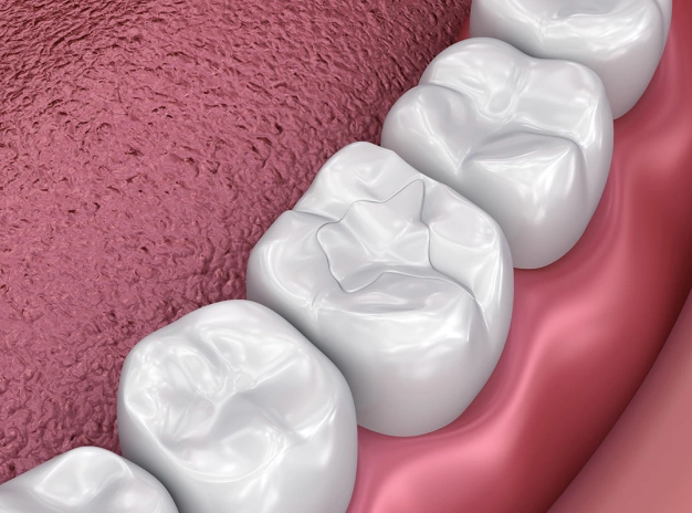 3D dental model showing white tooth crowns positioned on pink gum tissue structure.