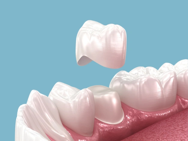 Dental crown being placed above model teeth against blue background, demonstrating restorative dentistry procedure.