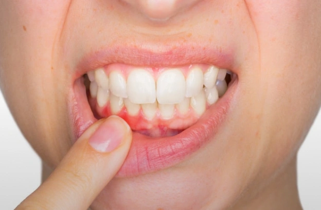 Person pointing to lower gum area showing signs of gum disease or inflammation.