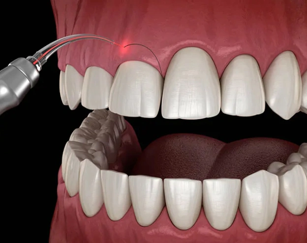 Dental laser treatment demonstration showing upper teeth alignment and gum contouring procedure.