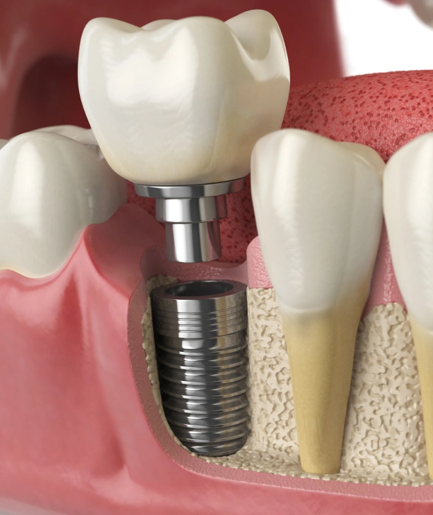 Dental implant model showing artificial tooth crown on metal implant post between natural teeth.