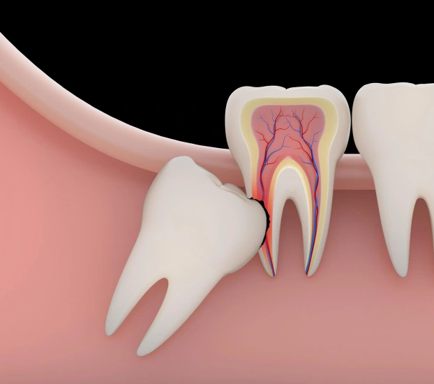 3D dental illustration showing tooth anatomy, cross-section, and impacted wisdom tooth in gum.