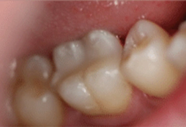 Close-up of natural teeth showing dental health and tooth structure in mouth.