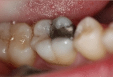 Close-up of lower teeth showing decay and discoloration on molars in mouth.