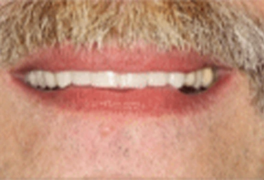 Close-up of a person's smile showing white teeth and natural lip color against skin.