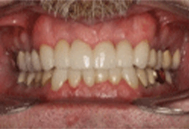 Close-up of teeth showing dental crowns and restorations in natural smile position.