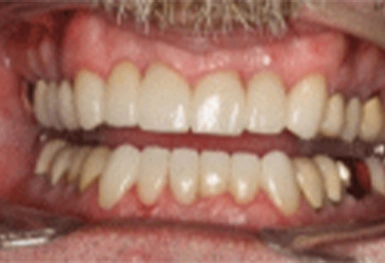 Close-up of upper and lower teeth showing dental alignment and tooth color during examination.