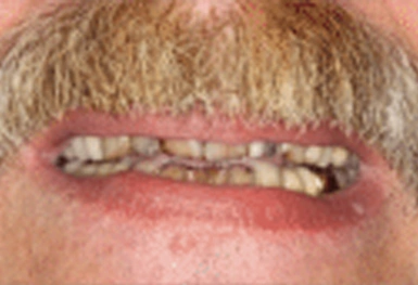 Close-up of open mouth showing upper teeth with dental work and natural lower teeth.