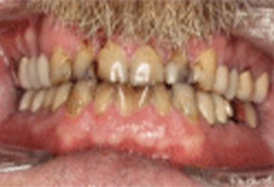 Close-up of teeth showing discoloration and wear, dental condition example for treatment discussion.