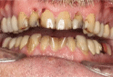 Close-up of teeth showing significant yellowing and decay, demonstrating need for dental treatment.