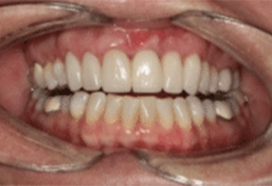 Close-up of a person's smile showing upper and lower teeth with visible gum tissue.