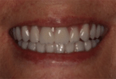 Close-up of a bright, white dental smile showing upper teeth with healthy gums and professional cosmetic dentistry results.