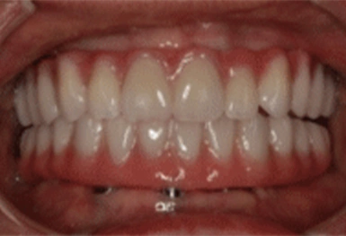 Close-up of upper and lower teeth showing proper dental alignment and healthy gum tissue.