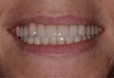 Close-up of a person's smile showing white, evenly-aligned teeth and healthy gums.