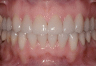 Close-up view of healthy aligned teeth and pink gums in dental setting.