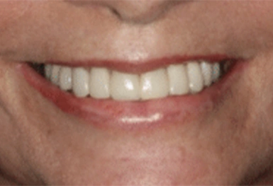 Close-up of a person's smile showing white, straight teeth and healthy gums.