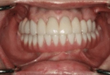 Close-up view of complete set of white dental prosthetics or dentures displayed in mouth.