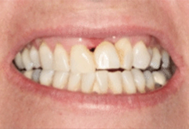 Close-up of teeth showing dental alignment and bite, demonstrating orthodontic or cosmetic dental results.