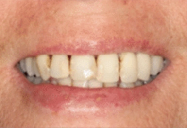 Close-up of a person's smile showing straight, white teeth and healthy gums.