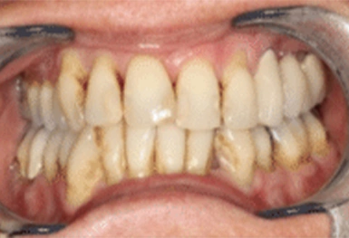 Close-up of dental teeth showing misalignment and discoloration requiring orthodontic treatment.