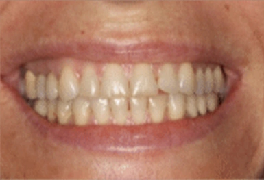 Close-up of a person's smile showing straight, white teeth and healthy gums.