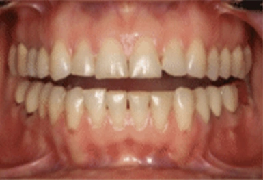 Close-up view of upper and lower teeth showing dental alignment and natural tooth coloring in clinical setting.
