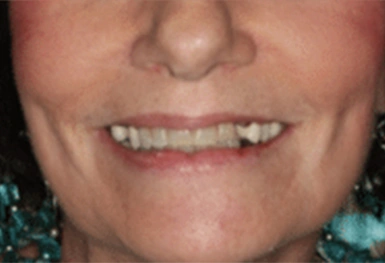 Close-up of person's smile showing teeth and lower face against neutral background.