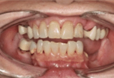 Close-up intraoral view of upper and lower teeth showing dental alignment and oral health assessment.