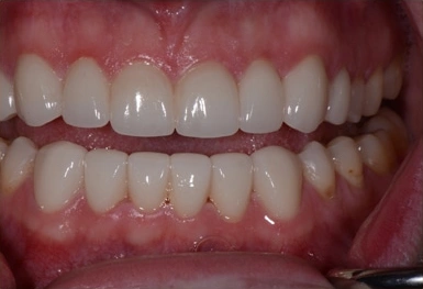 Close-up view of healthy upper and lower teeth showing proper alignment and white dental appearance.