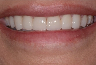 Close-up of a person's smile showing white, evenly-aligned upper teeth and pink gums.