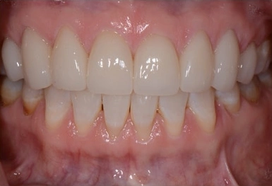 Close-up of healthy white teeth and pink gums in a dental examination setting.