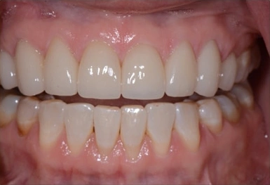 Close-up view of upper and lower teeth showing dental alignment and oral health condition.